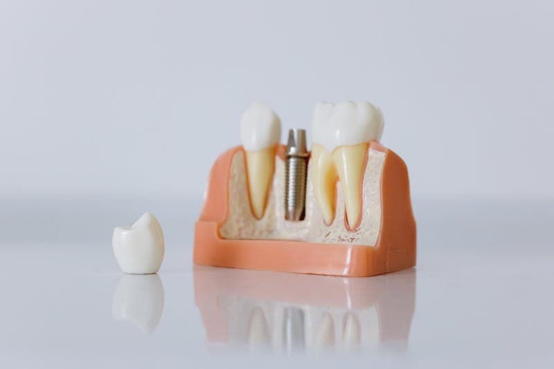 Dental Implants in Vadodara