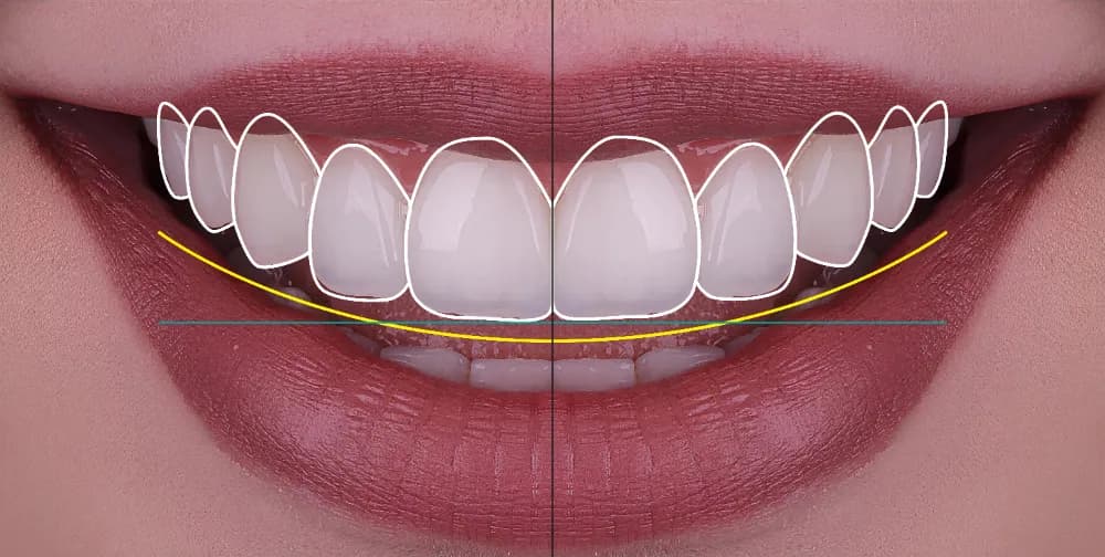 Smile Designing