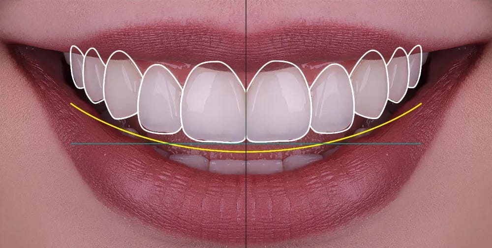 Smile Designing in Vadodara — Ashirvad Dental Clinic