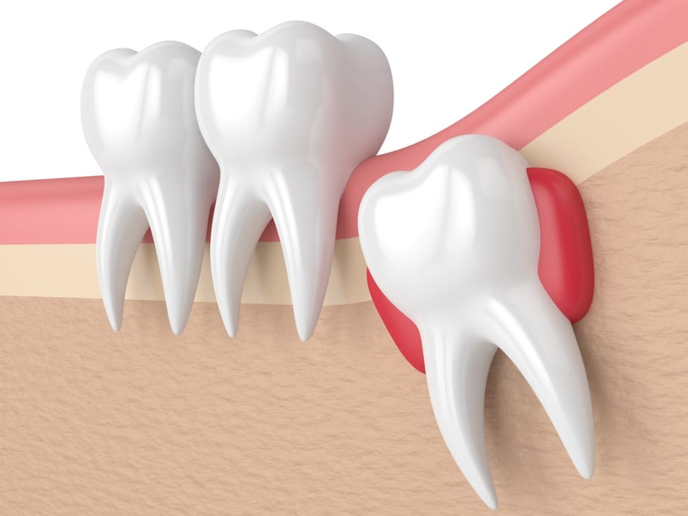 Wisdom Tooth Removal in Vadodara — Ashirvad Dental Clinic